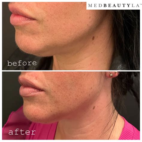 KYBELLA® Before and After .